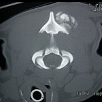 CT scan of osteochondrosarcoma