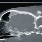 CT scan of osteochondrosarcoma 2